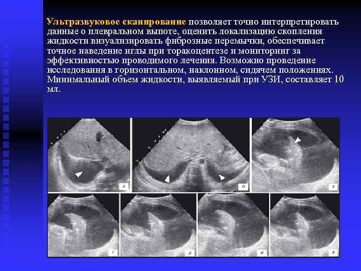  Ультразвуковое сканирование позволяет точно интерпретировать данные о плевральном выпоте, оценить локализацию скопления жидкости