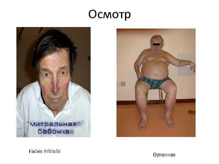 Осмотр Facies mitralis Ортопноэ 
