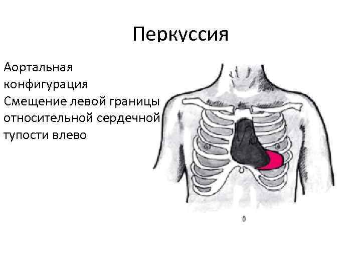Перкуссия Аортальная конфигурация Смещение левой границы относительной сердечной тупости влево 