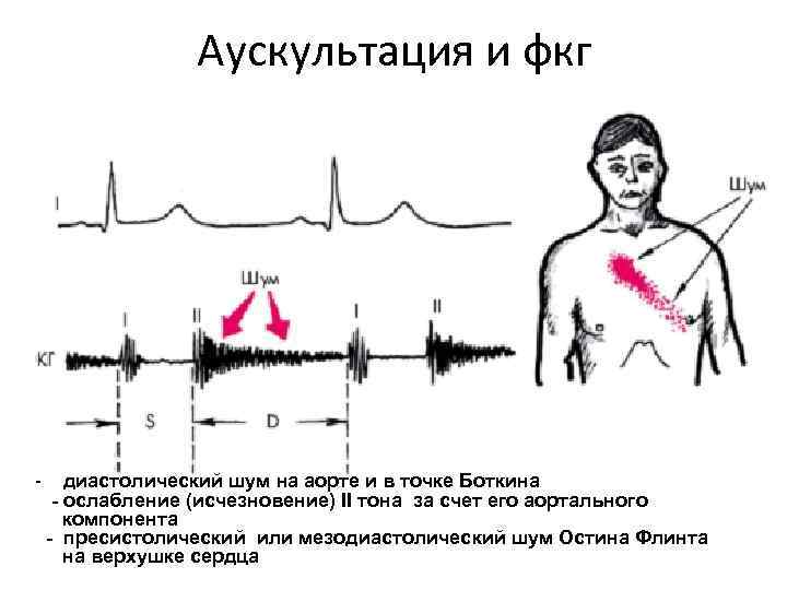 Аускультация и фкг - диастолический шум на аорте и в точке Боткина - ослабление