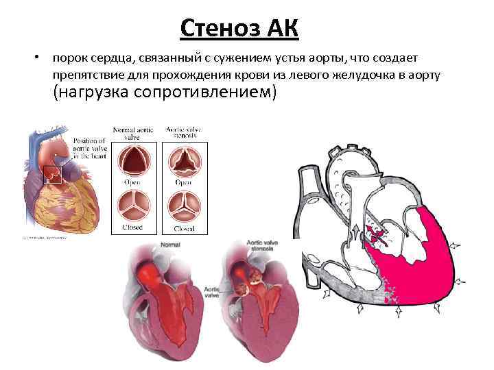 Стеноз АК • порок сердца, связанный с сужением устья аорты, что создает препятствие для