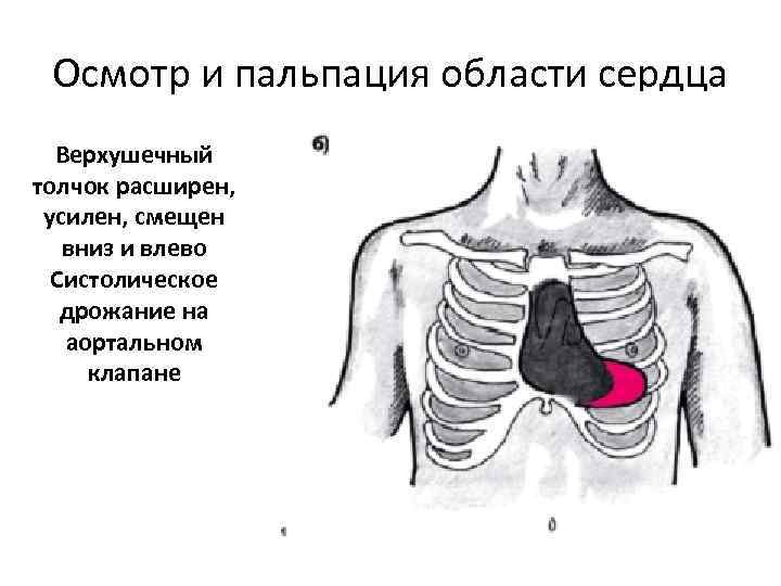 Осмотр и пальпация области сердца Верхушечный толчок расширен, усилен, смещен вниз и влево Систолическое