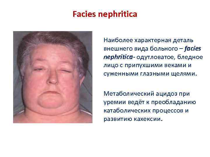 Facies nephritica Наиболее характерная деталь внешнего вида больного – facies nephritica- одутловатое, бледное лицо