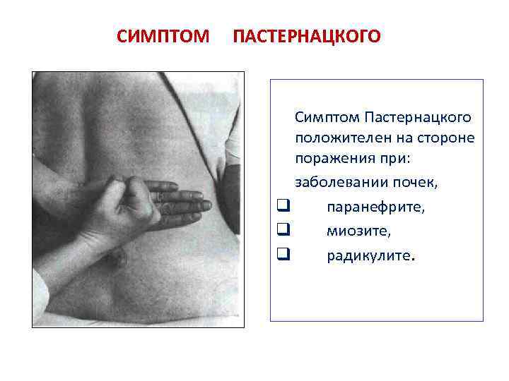 СИМПТОМ ПАСТЕРНАЦКОГО Симптом Пастернацкого положителен на стороне поражения при: заболевании почек, q паранефрите, q