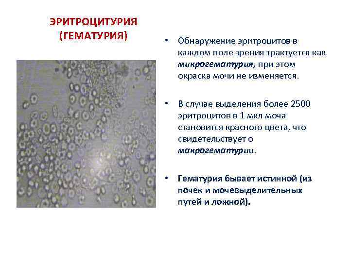 ЭРИТРОЦИТУРИЯ (ГЕМАТУРИЯ) • Обнаружение эритроцитов в каждом поле зрения трактуется как микрогематурия, при этом