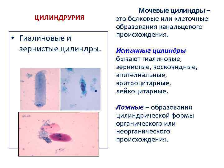 ЦИЛИНДРУРИЯ • Гиалиновые и зернистые цилиндры. Мочевые цилиндры – это белковые или клеточные образования