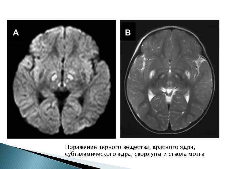 Поражение черного вещества, красного ядра, субталамического ядра, скорлупы и ствола мозга 