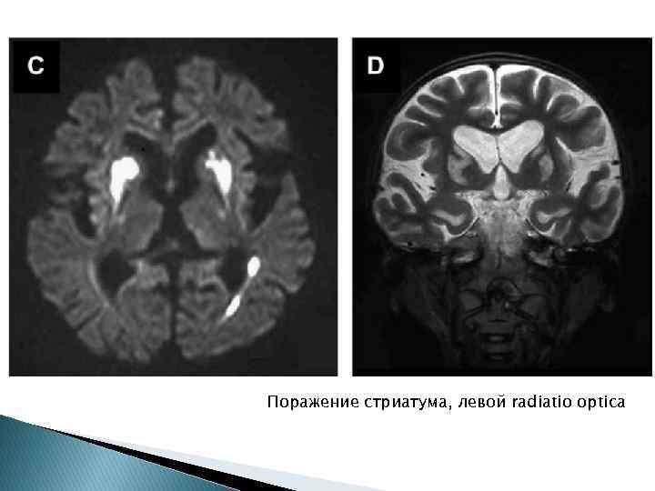 Поражение стриатума, левой radiatio optica 