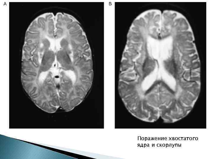 Поражение хвостатого ядра и скорлупы 