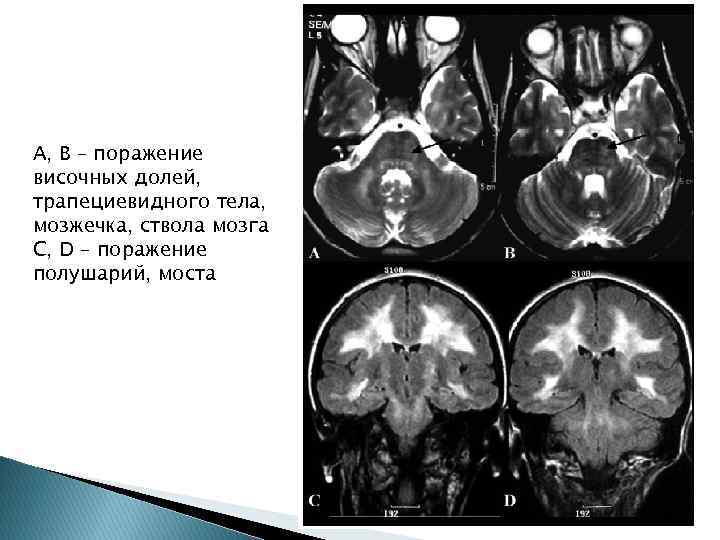 A, B – поражение височных долей, трапециевидного тела, мозжечка, ствола мозга C, D –