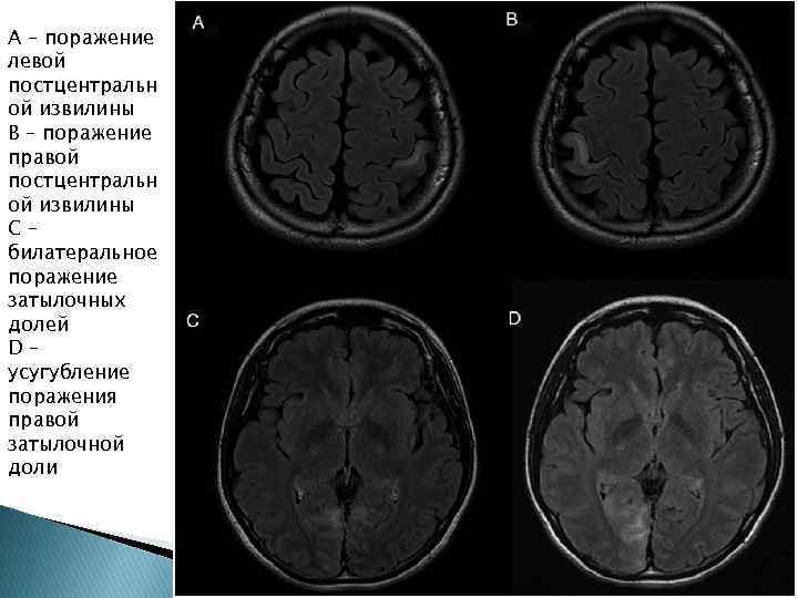 A – поражение левой постцентральн ой извилины B – поражение правой постцентральн ой извилины