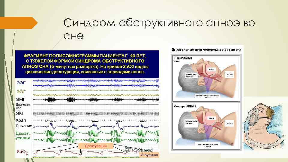 Синдром ночного апноэ презентация