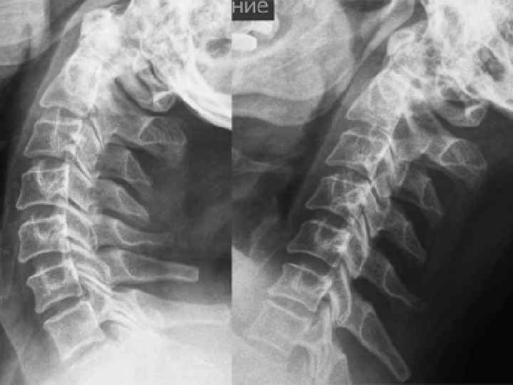 Рентген шейного отдела позвоночника с функциональными пробами. Болезнь Форестье шейного отдела рентген. Шейный лордоз выпрямлен с тенденцией к кифотической деформации.. Кифотическая установка рентген.