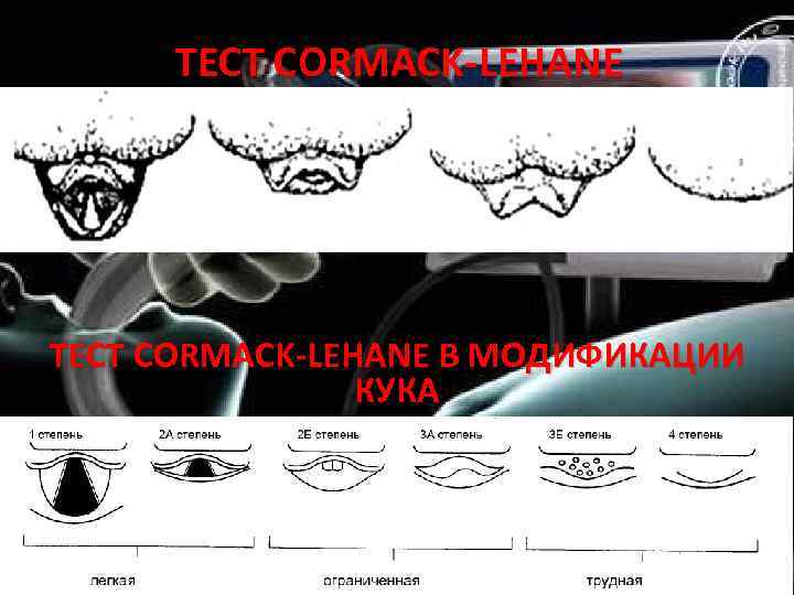 ТЕСТ CORMACK-LEHANE В МОДИФИКАЦИИ КУКА 