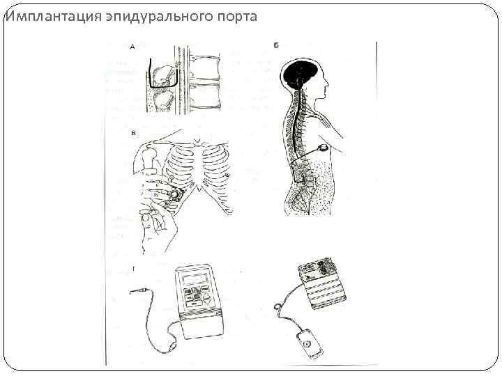 Имплантация эпидурального порта 