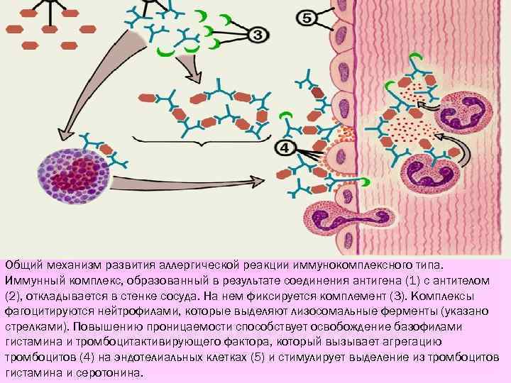 Общий механизм развития аллергической реакции иммунокомплексного типа. Иммунный комплекс, образованный в результате соединения антигена