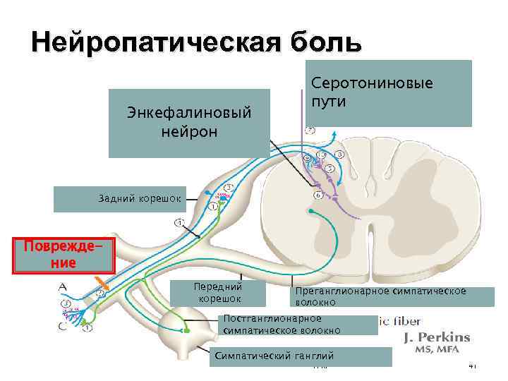 Нейропатическая боль Энкефалиновый нейрон Серотониновые пути Задний корешок Повреждение Передний корешок Преганглионарное симпатическое волокно