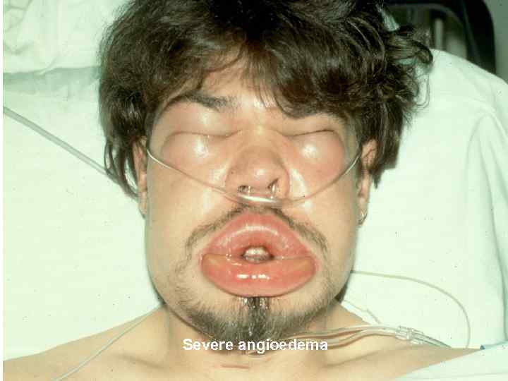  Severe angioedema 