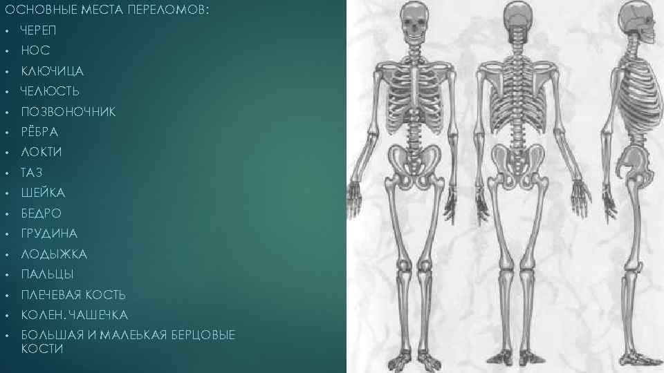 ОСНОВНЫЕ МЕСТА ПЕРЕЛОМОВ: • ЧЕРЕП • НОС • КЛЮЧИЦА • ЧЕЛЮСТЬ • ПОЗВОНОЧНИК •