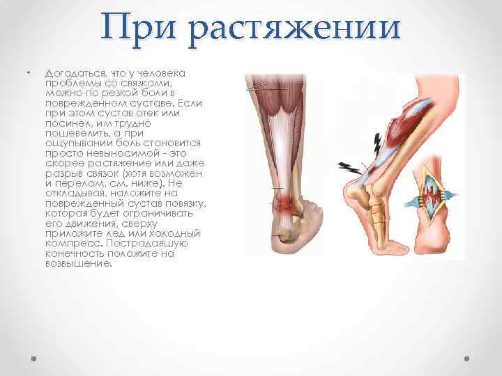 При растяжении • Догадаться, что у человека проблемы со связками, можно по резкой боли