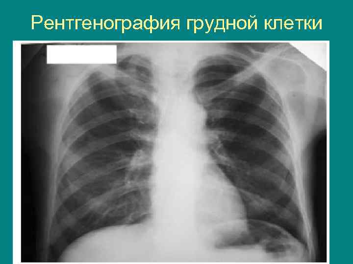 Рентгенография грудной клетки 