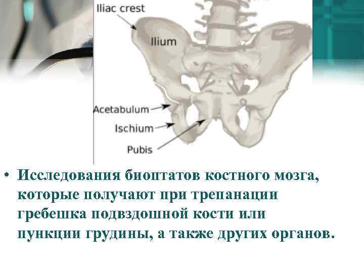  • Исследования биоптатов костного мозга, которые получают при трепанации гребешка подвздошной кости или