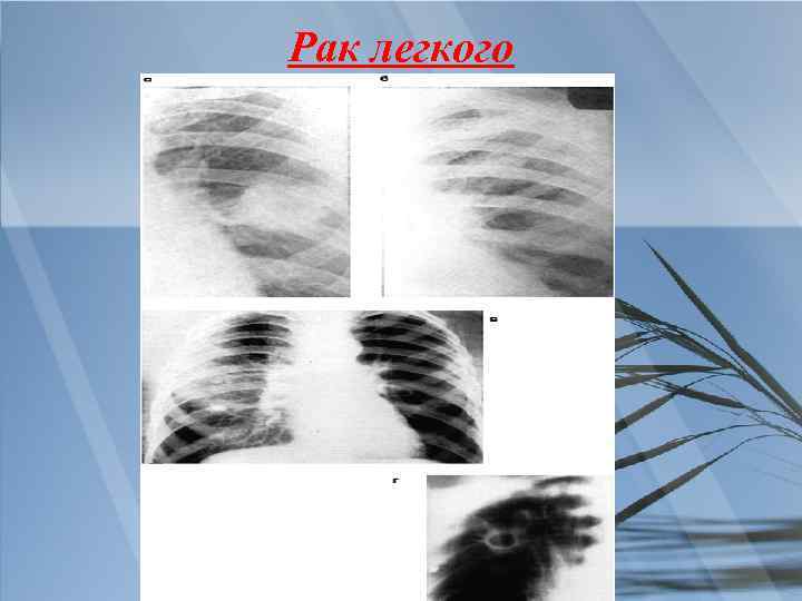 Рак легкого 