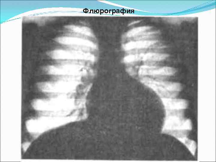  Флюрография 