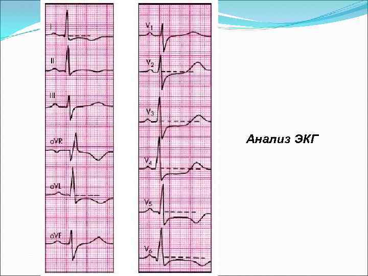  Анализ ЭКГ 