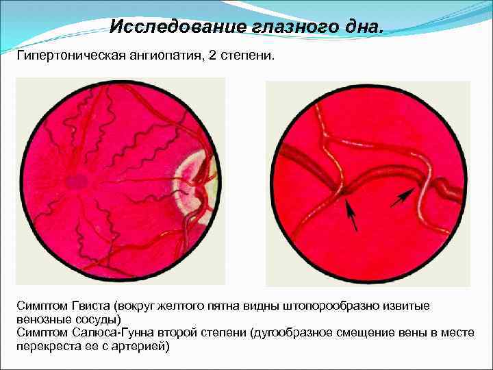 Исследование глазного дна. Гипертоническая ангиопатия, 2 степени. Симптом Гвиста (вокруг желтого пятна видны штопорообразно
