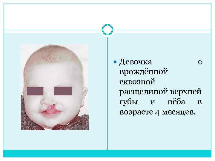  Девочка с врождённой сквозной расщелиной верхней губы и нёба в возрасте 4 месяцев.