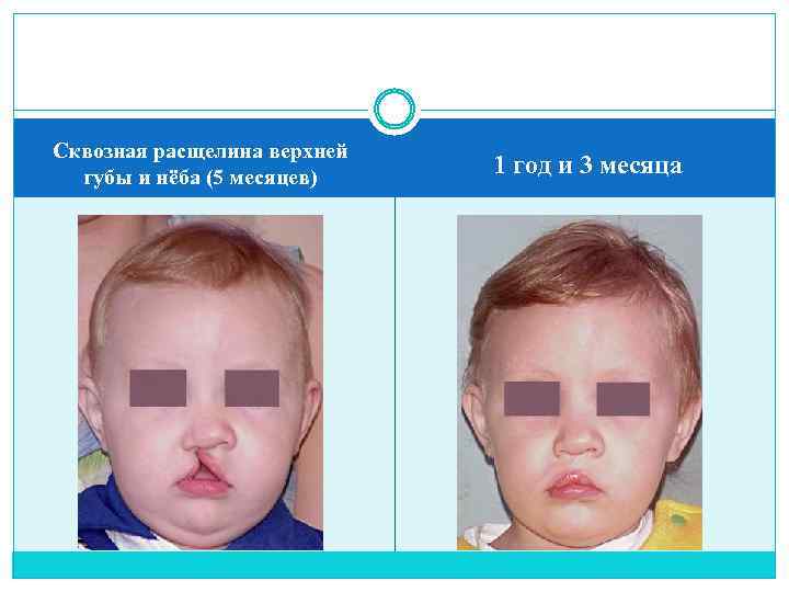 Сквозная расщелина верхней губы и нёба (5 месяцев) 1 год и 3 месяца 