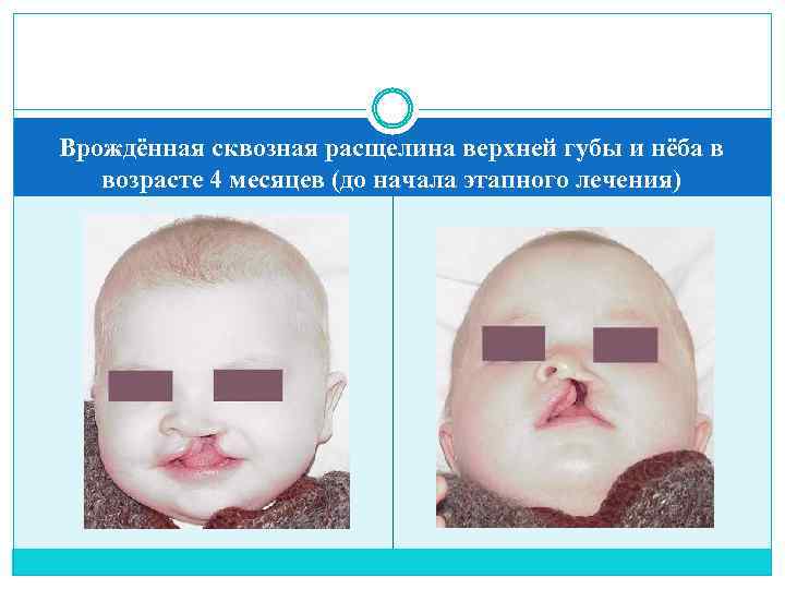 Врождённая сквозная расщелина верхней губы и нёба в возрасте 4 месяцев (до начала этапного