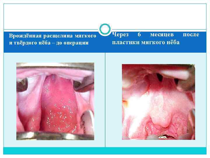 Врождённая расщелина мягкого и твёрдого нёба – до операции Через 6 месяцев после пластики