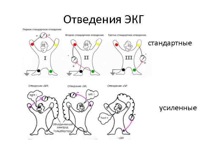 Дополнительные отведения экг презентация