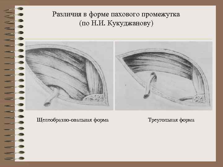 Различия в форме пахового промежутка (по Н. И. Кукуджанову) Щелеобразно-овальная форма Треугольная форма 