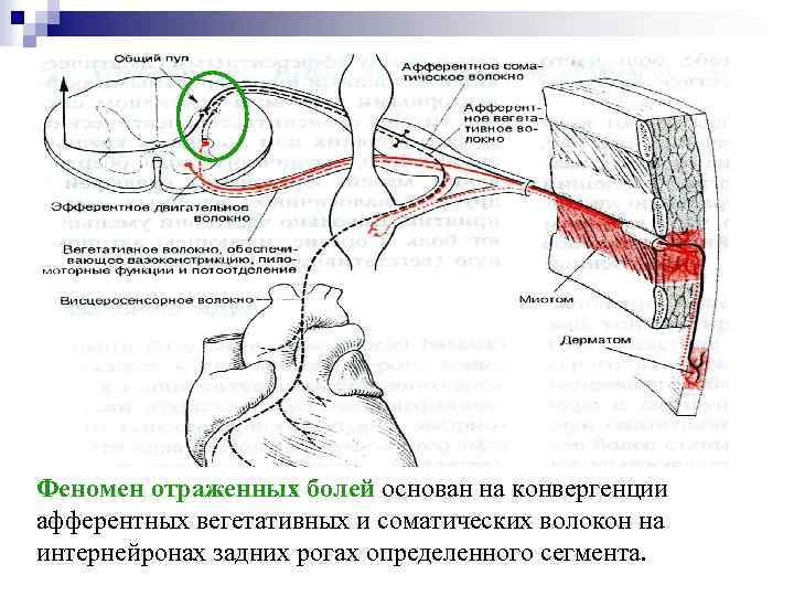 Феномен отраженных болей основан на конвергенции афферентных вегетативных и соматических волокон на интернейронах задних