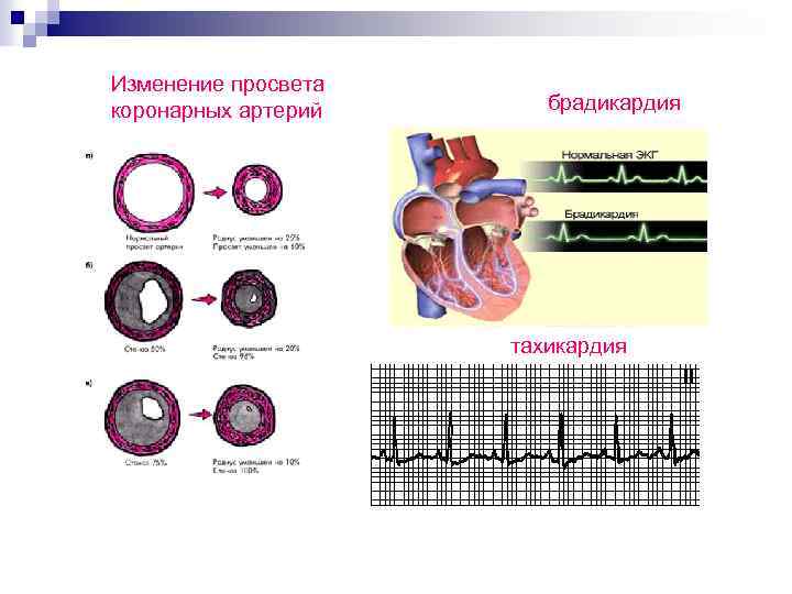 Изменение просвета коронарных артерий брадикардия тахикардия 