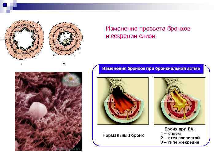 Изменение просвета бронхов и секреции слизи 