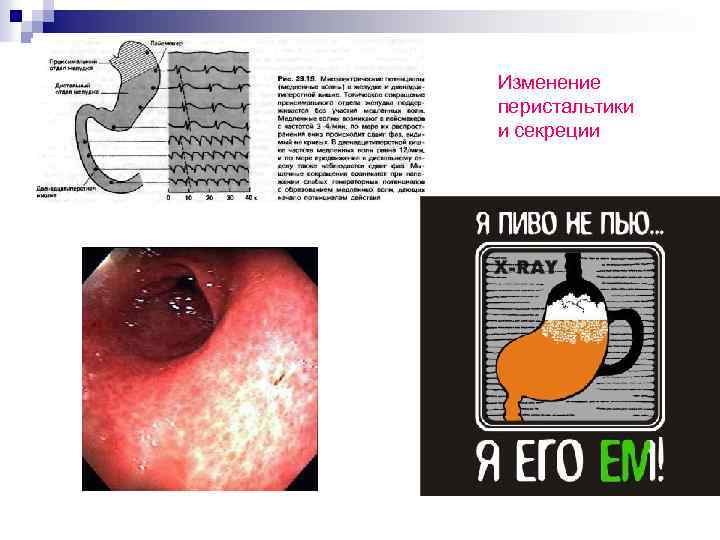 Изменение перистальтики и секреции 