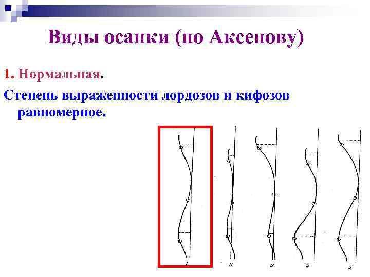 Виды осанки (по Аксенову) 1. Нормальная. Степень выраженности лордозов и кифозов равномерное. 