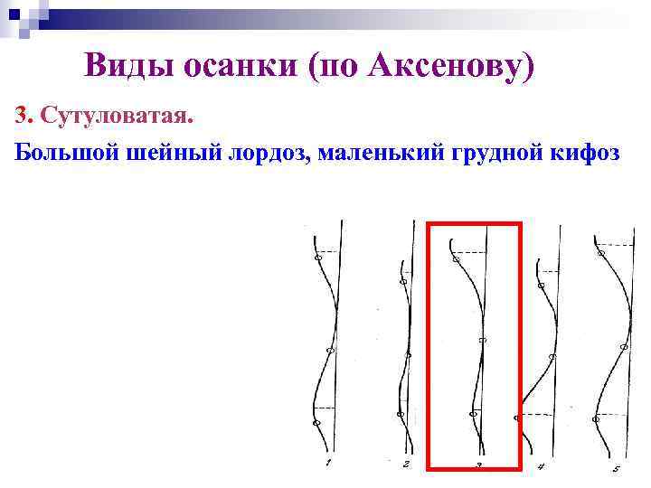 Виды осанки (по Аксенову) 3. Сутуловатая. Большой шейный лордоз, маленький грудной кифоз 