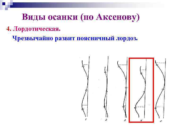 Виды осанки (по Аксенову) 4. Лордотическая. Чрезвычайно развит поясничный лордоз. 