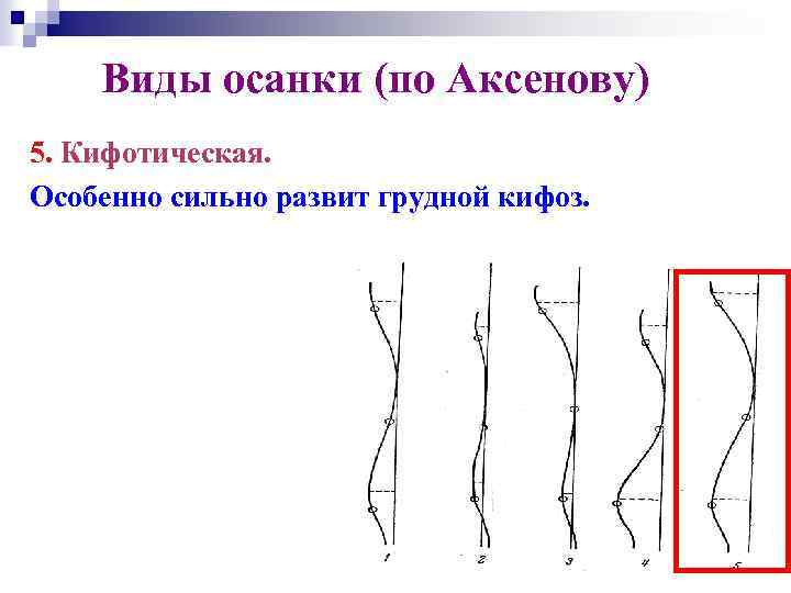 Виды осанки (по Аксенову) 5. Кифотическая. Особенно сильно развит грудной кифоз. 