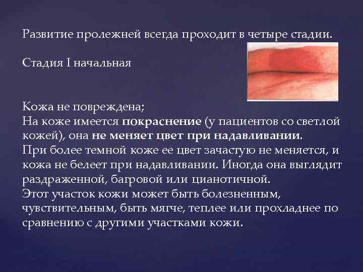 Развитие пролежней всегда проходит в четыре стадии. Стадия I начальная Кожа не повреждена; На