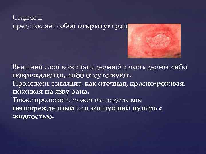 Стадия II представляет собой открытую рану: Внешний слой кожи (эпидермис) и часть дермы либо