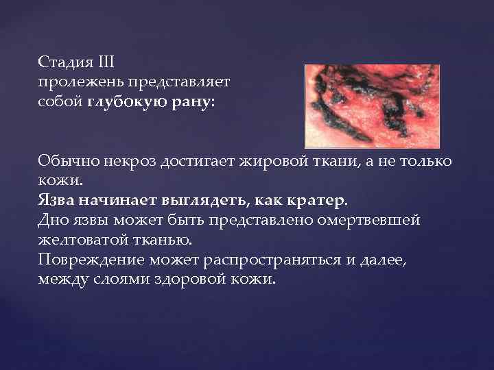 Стадия III пролежень представляет собой глубокую рану: Обычно некроз достигает жировой ткани, а не