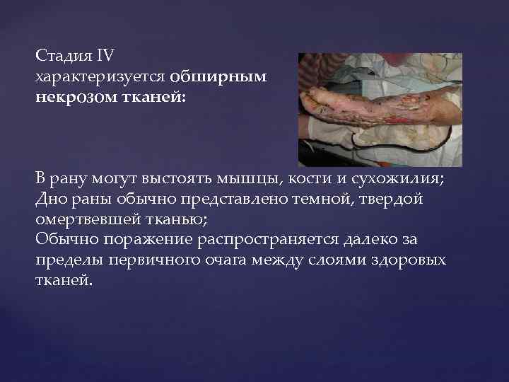 Стадия IV характеризуется обширным некрозом тканей: В рану могут выстоять мышцы, кости и сухожилия;