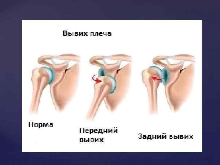 Травмы плеча презентация