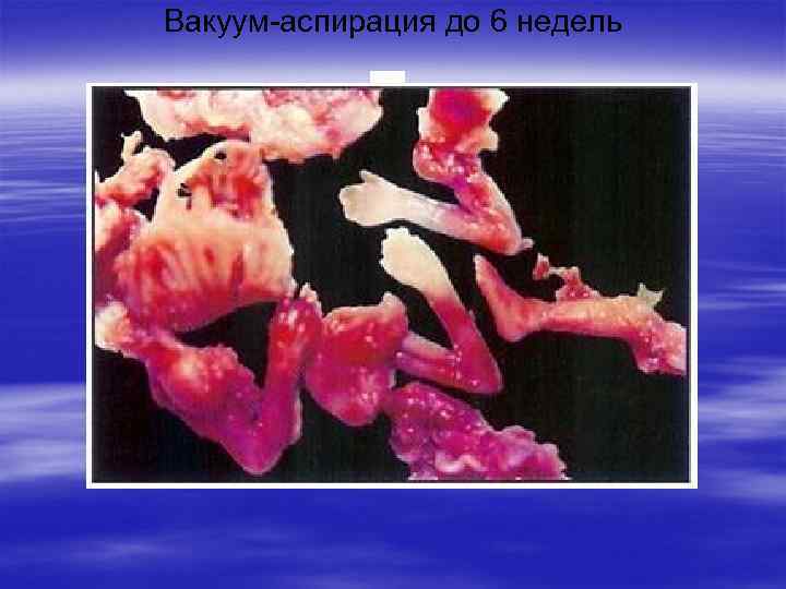 Вакуум-аспирация до 6 недель 
